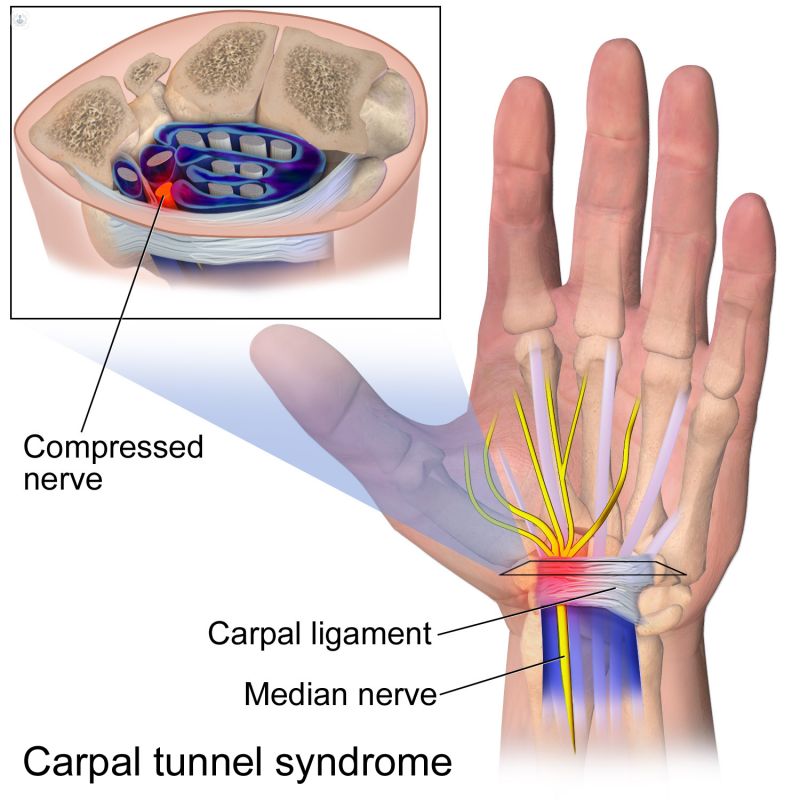 Carpal Tunnel Syndrome - Perth Orthopaedic Specialist Centre