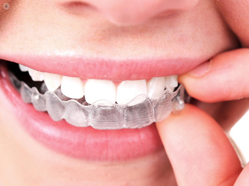 Are Invisalign Braces the Best Option for Overbite Treatment
