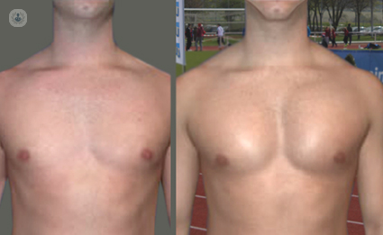 NewTampaPlasticSurgery on X: Tired of working out your pecs and not seeing  the results you want? We can help! Pectoral implant surgery is an excellent  option for men who desire a fuller