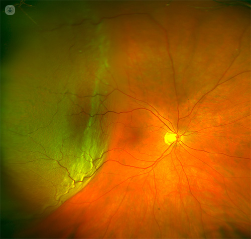 What is a Detached Retina?  Symptoms, Causes and Treatment
