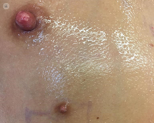 Nipples: what's normal and why do we have them?