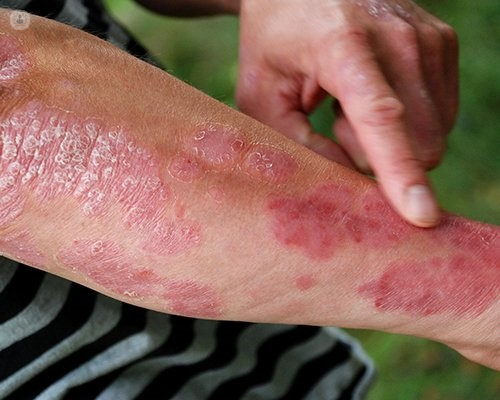 circular skin rashes on arms