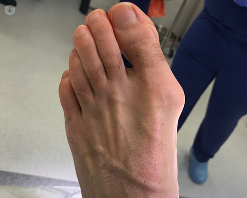 Bunions & Foot Problems - What is a Bunion