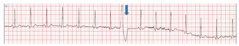 Can Anxiety Cause Abnormal Ekg Captions Week