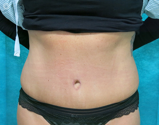Laura's abdominoplasty tummy tuck (with pictures)
