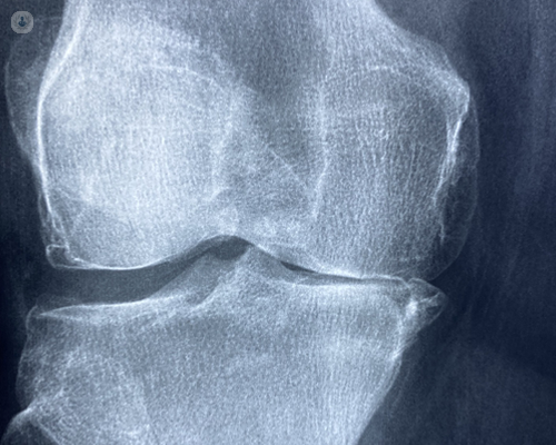 X-ray of knee that requires a medial unicompartmental knee replacement