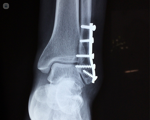 Ankle Sprain & Fracture Surgeries