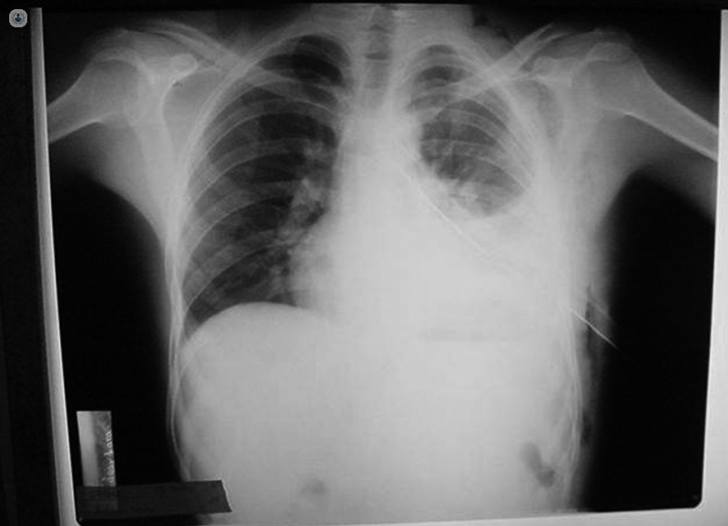 hemo pneumothorax x ray