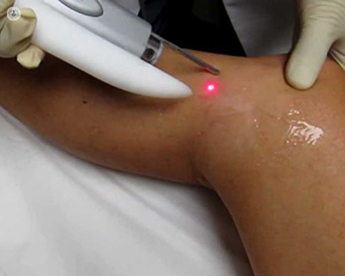 Laser treatment for varicose veins and spider veins