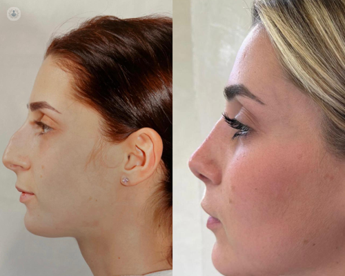 Patient of Mr Giovanni Ferrando, who has had a rhinoplasty