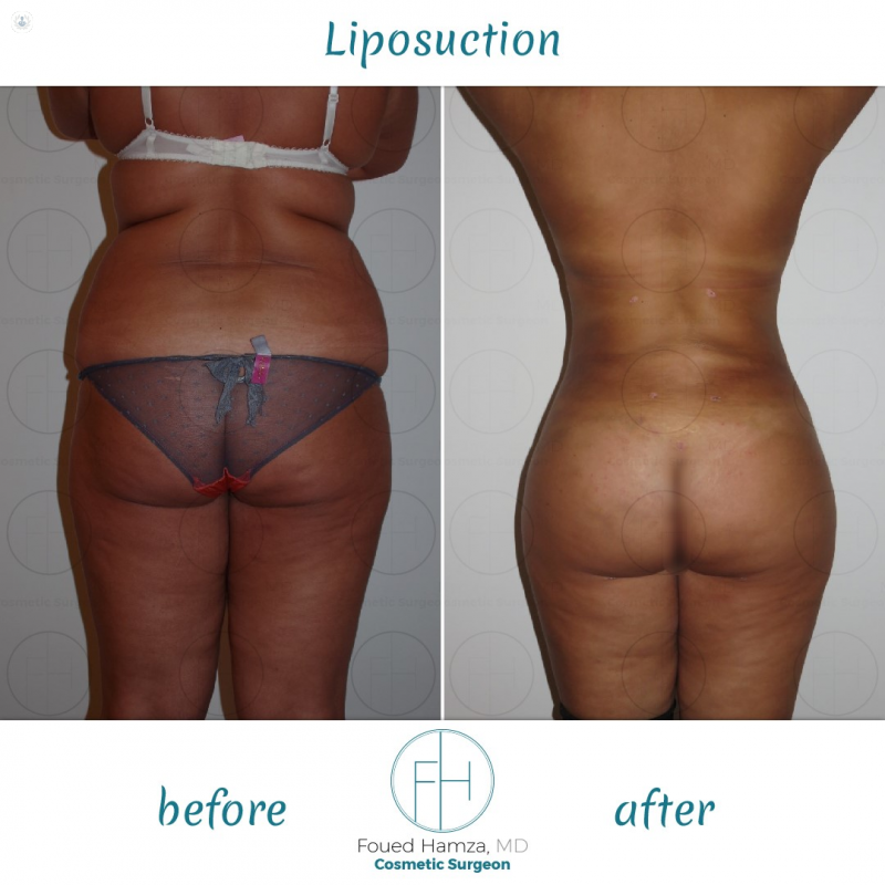 Sculpt Your Dream Body Without Surgery: Non-Surgical Body