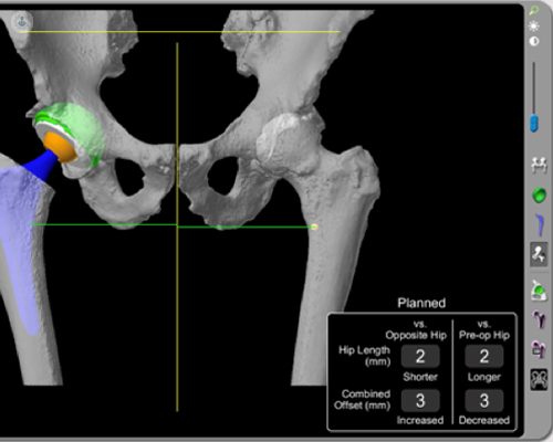 Pre-operative planning for robotic-assisted hip replacement surgery