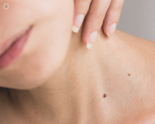 Spotting the difference between moles vs skin cancer.