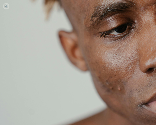 Young man with acne, which can be made worse by stress